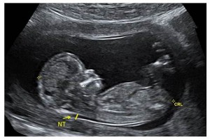 ultrasound image of fetus