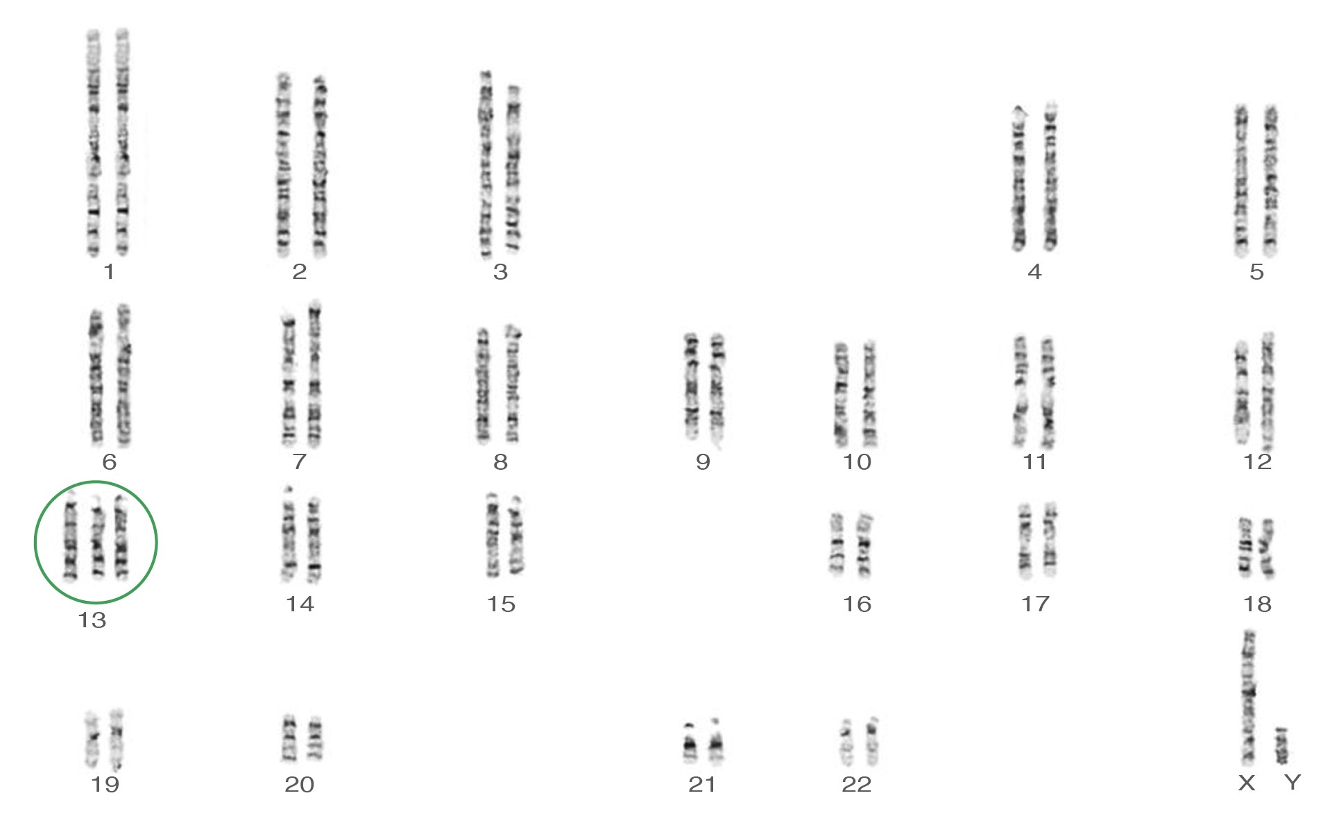 Trisomy 13 karyotype