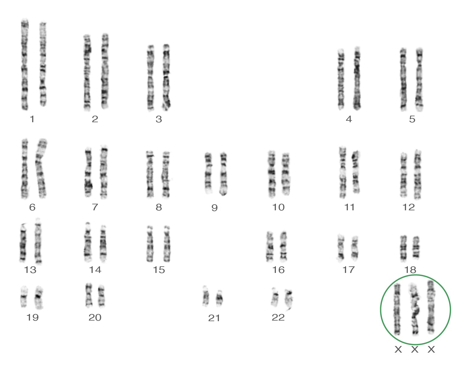 Sex Chromosome Differences Prenatal Screening Ontario