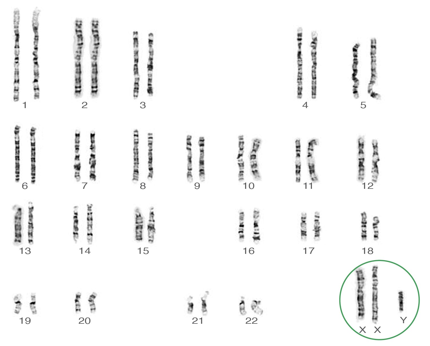 Caryotype du syndrome Klinefelter 