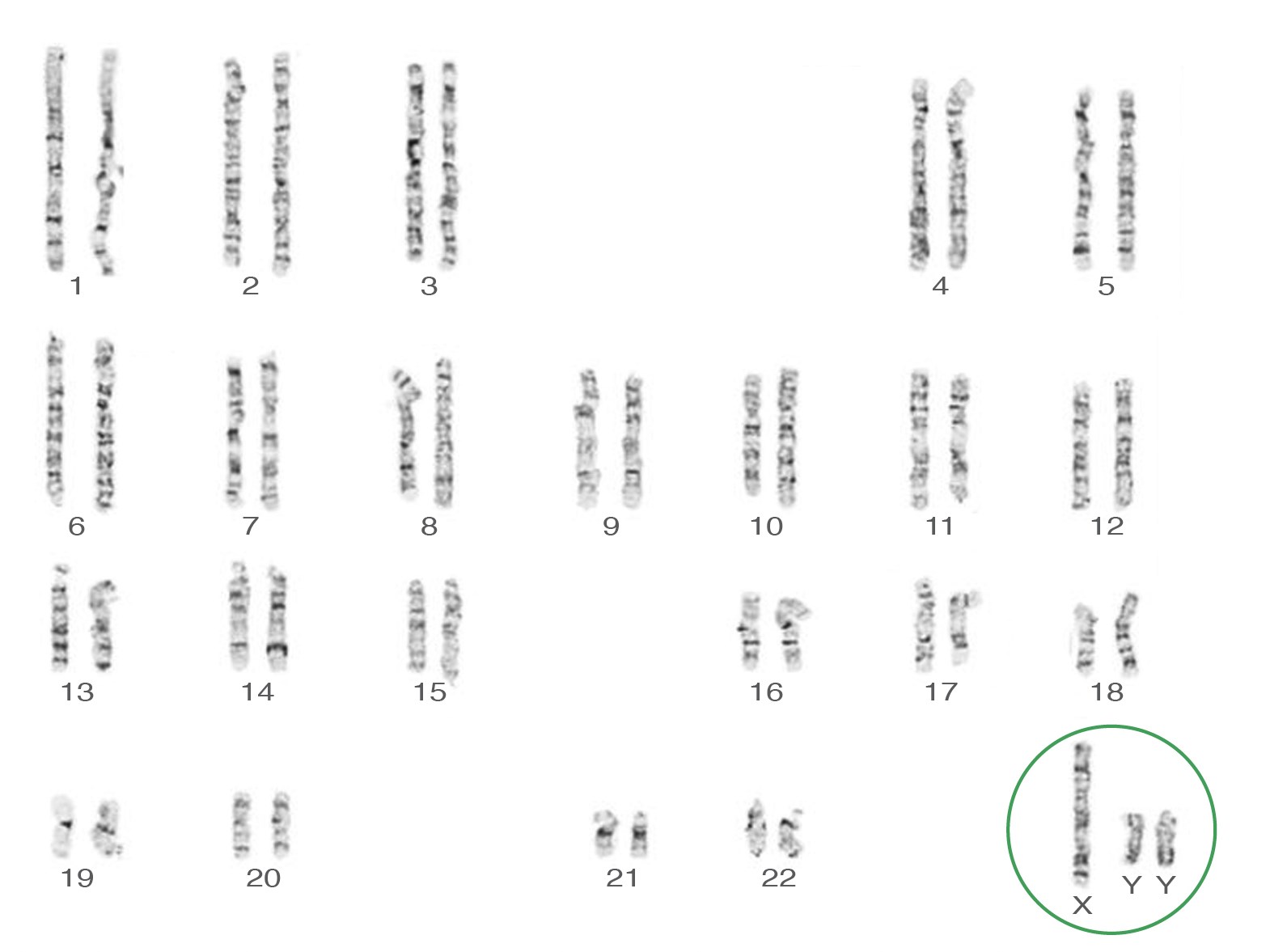  Caryotype du Syndrome XYY 