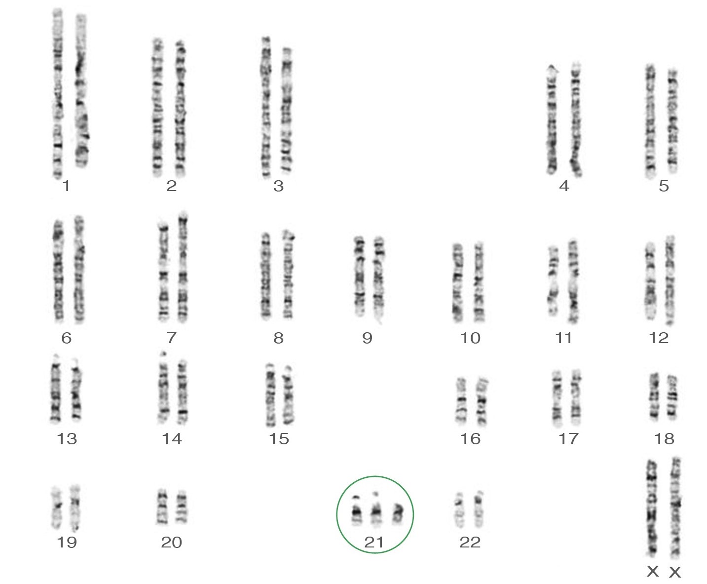 Trisomy 21 karyotype