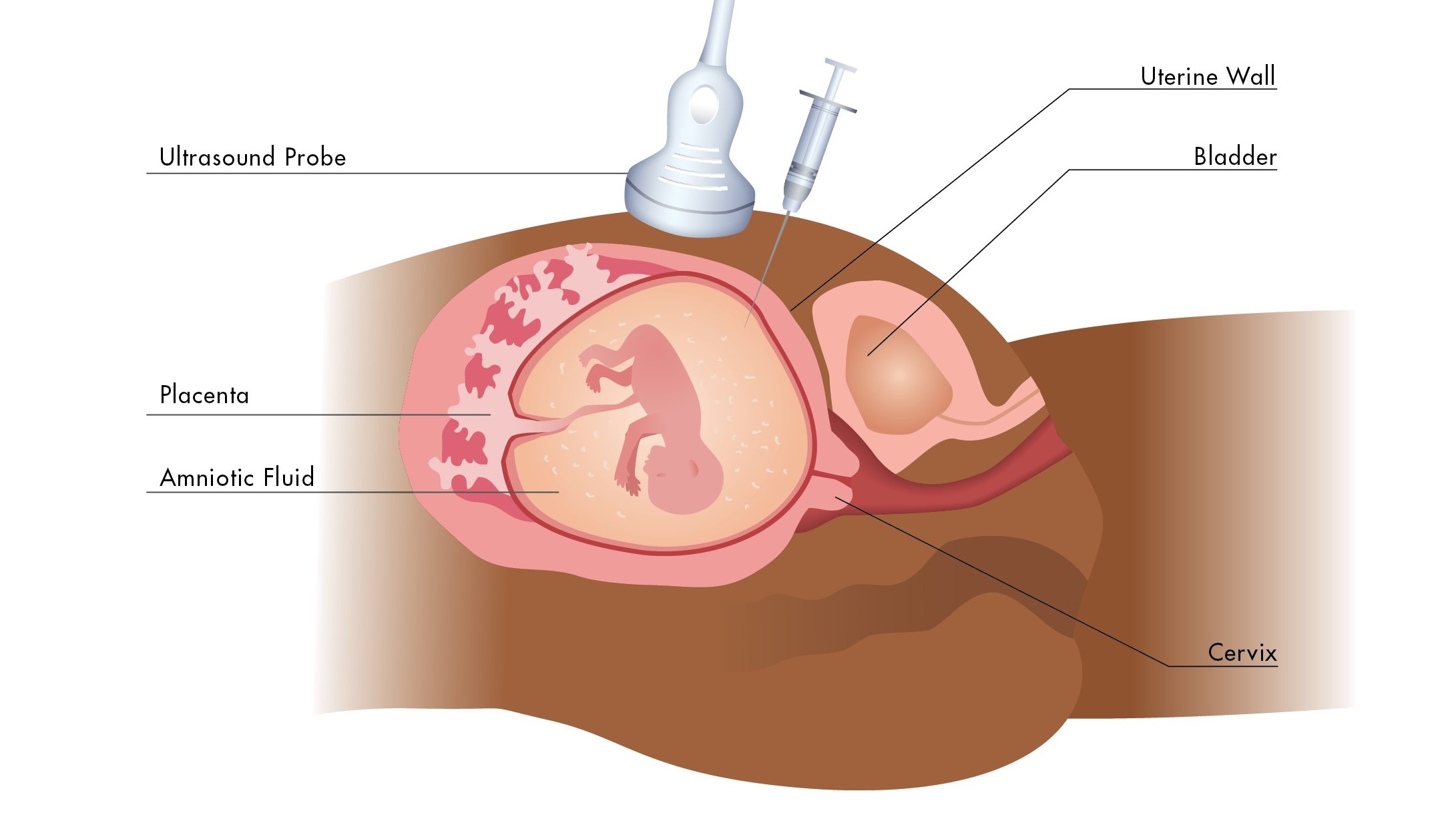 Amniocentesis